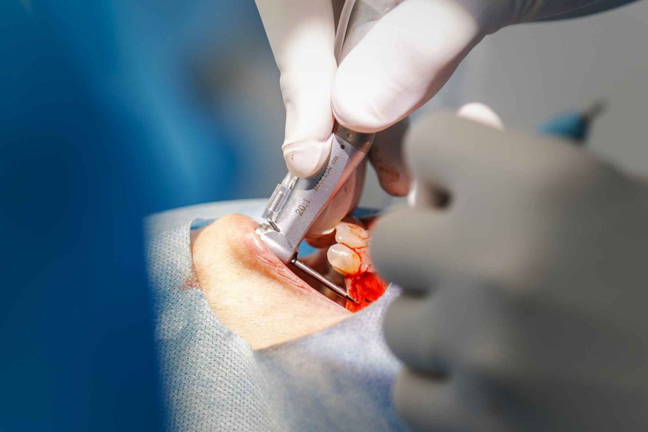 Formation implantologie chirurgie Initiale