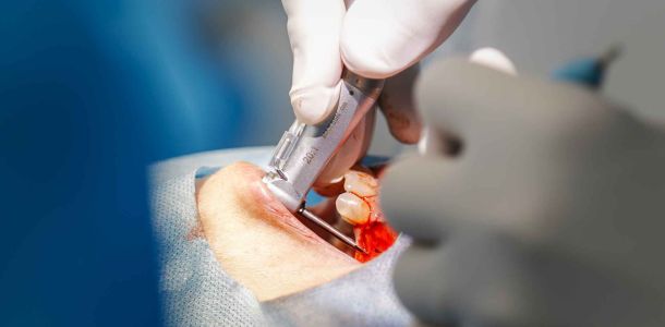 Formation implantologie chirurgie guidée