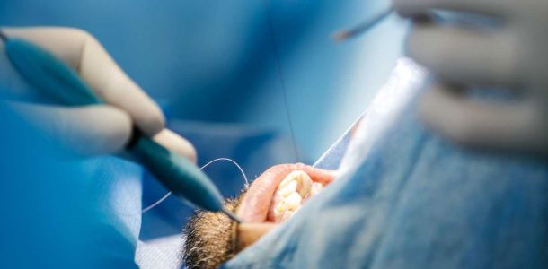 Formation implantologie chirurgie initiale